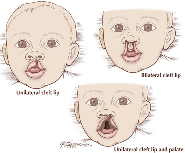 Cleft Lip and Palate Surgery